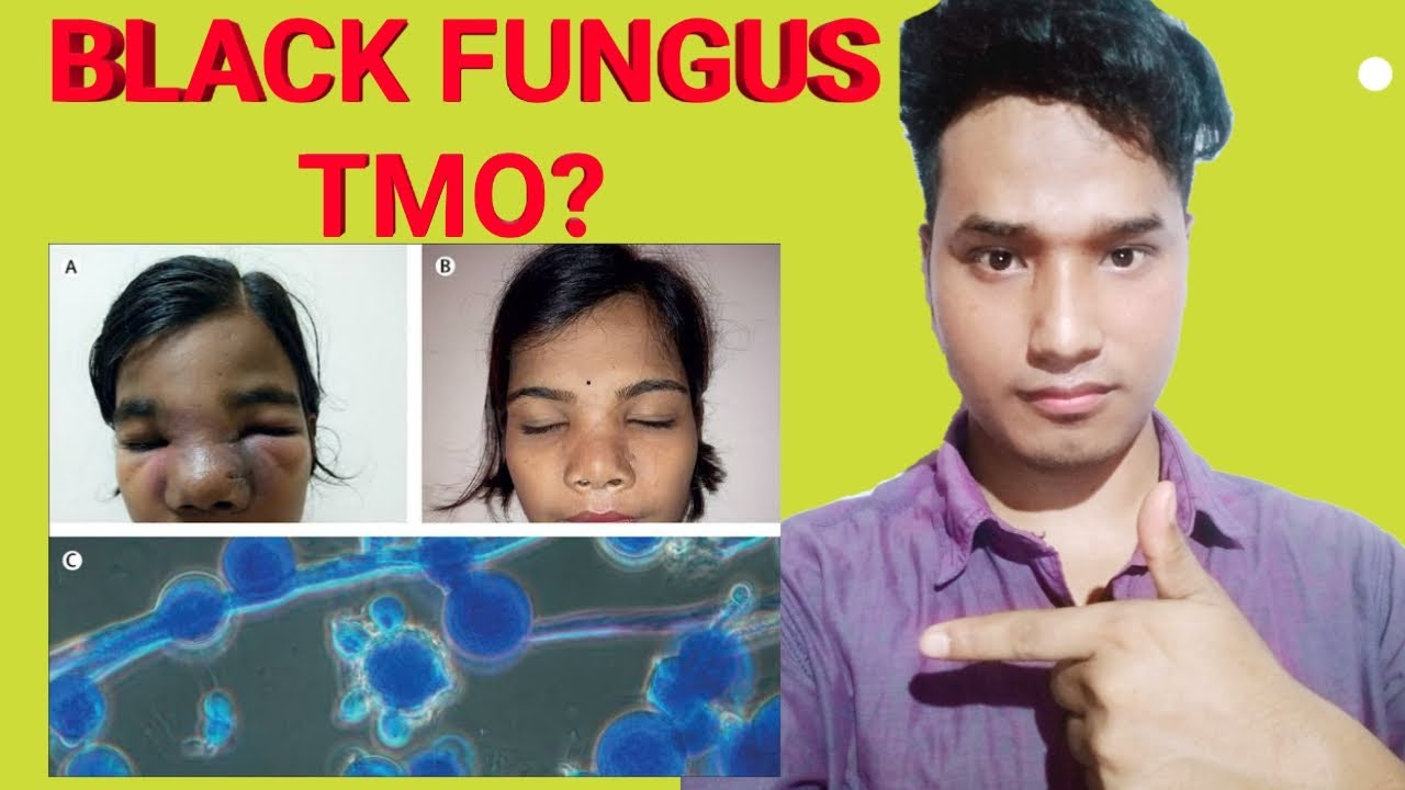 Black Fungus Tamo ? What is black Fungus Explanation By KAF a new