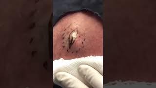 👉🏼💥👈🏼  #shorts #drpimplepopper #popaholics