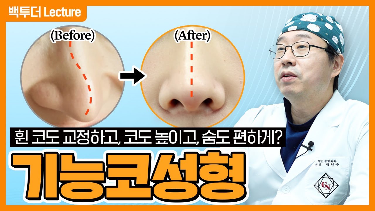 휜 코 고치러 왔다가, 미모도 얻고 갑니다!! ※기능코성형※
