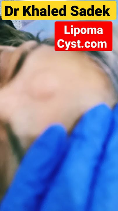 forehead lipoma #shorts #lipoma #cystremoval Dr Khaled Sadek Lipomacyst.com