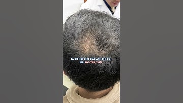 🔥 BẠN LO LẮNG VÌ TÓC RỤNG QUÁ NHIỀU? 🔥