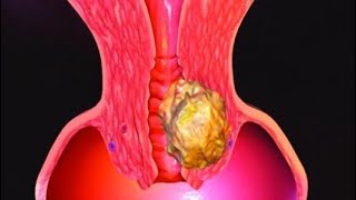 سرطان عنق الرحم وأعراضه سرطان عنق الرحم وأعراضه