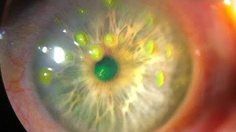 Filamentary Keratitis explained in detail @eyecareoptom5506 #cornea #optometry 