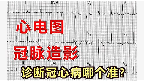 心电图，能诊断冠心病吗？心脏医生提醒：不是所有人都要冠脉造影 - 天天要闻