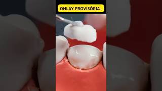 Im É Uma Onlay