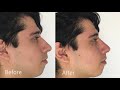 Non surgical nose job by dr rivkin