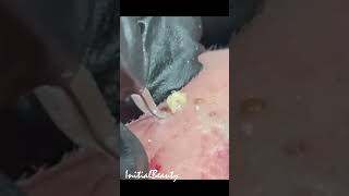 Giant blackhead removal 6