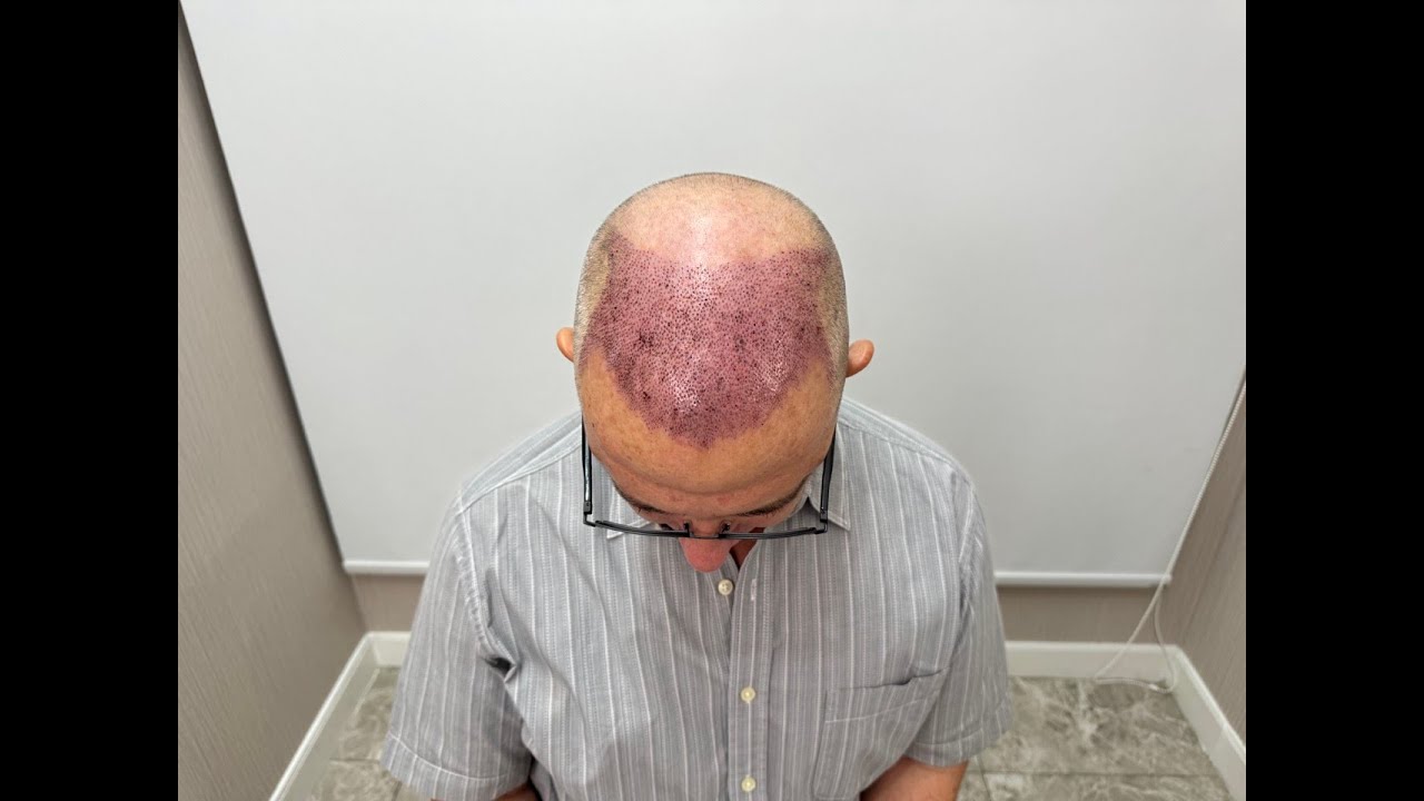 My Hair Transplant Journey 3 Month Check Up. Am I Happy With The Progress? Vlog 105-24