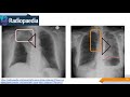 Imagenología de Tórax: Signos Radiológicos