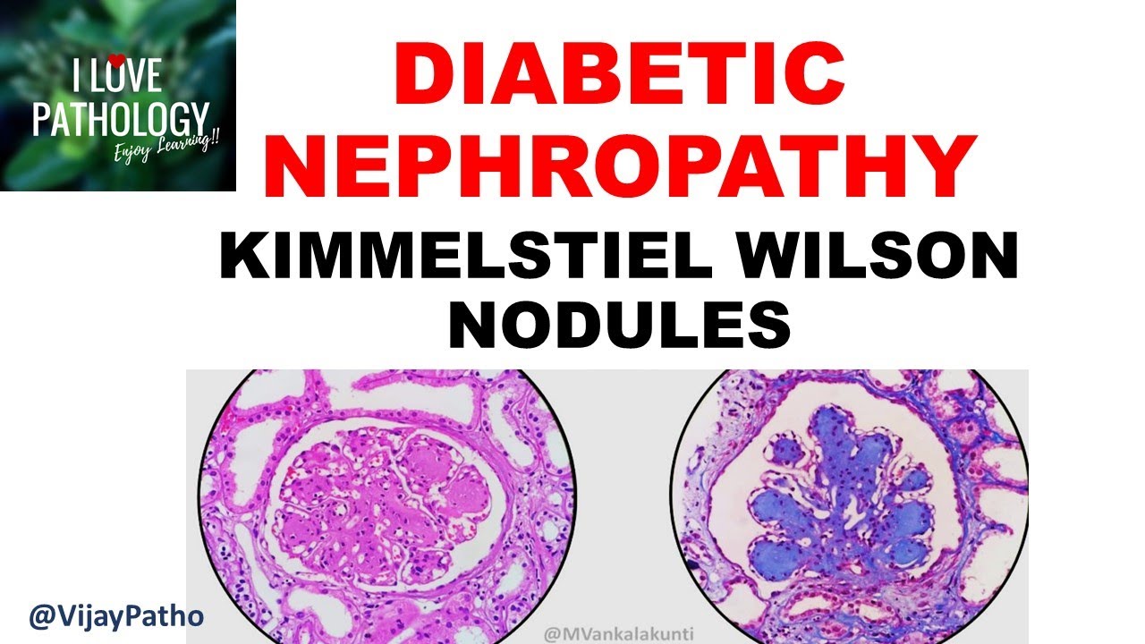 diabetic-nephropathy-pathophysiology-morphology-youtube