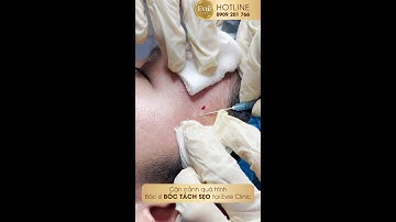 Cận cảnh quá trình bóc tách sẹo tại Phòng Khám Evie