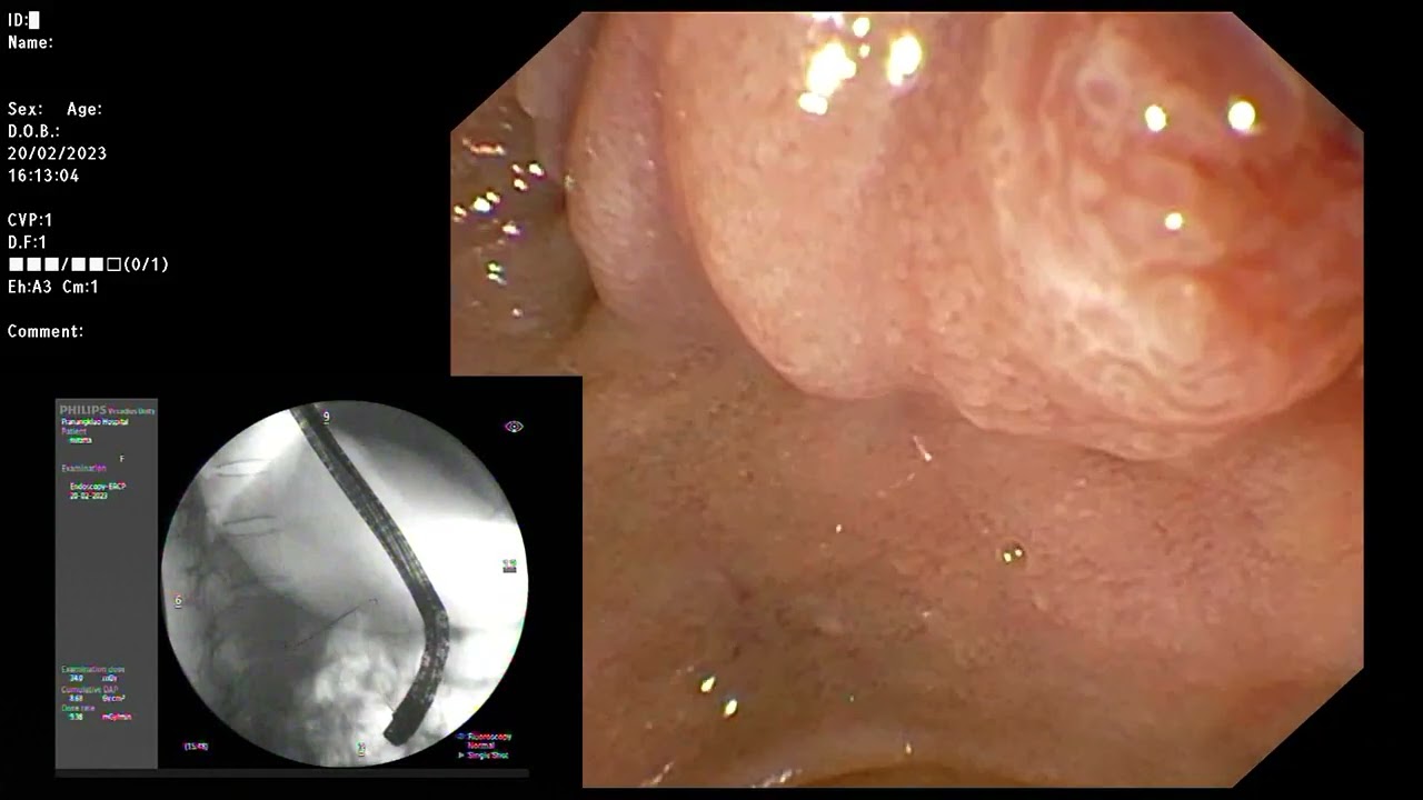 ERCP ; Fluoroscopic clips of DG cannulation technique.
