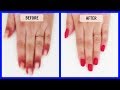 How to get rid of dark skin around the nails in just 7 Days