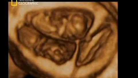 ¿Puede un feto absorber a su gemelo?