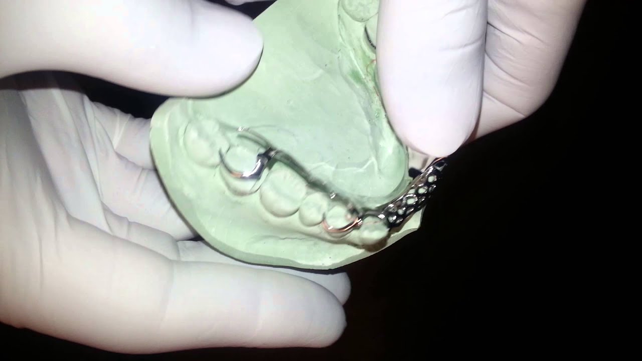 Orthodontics With A Partial Denture - Youtube