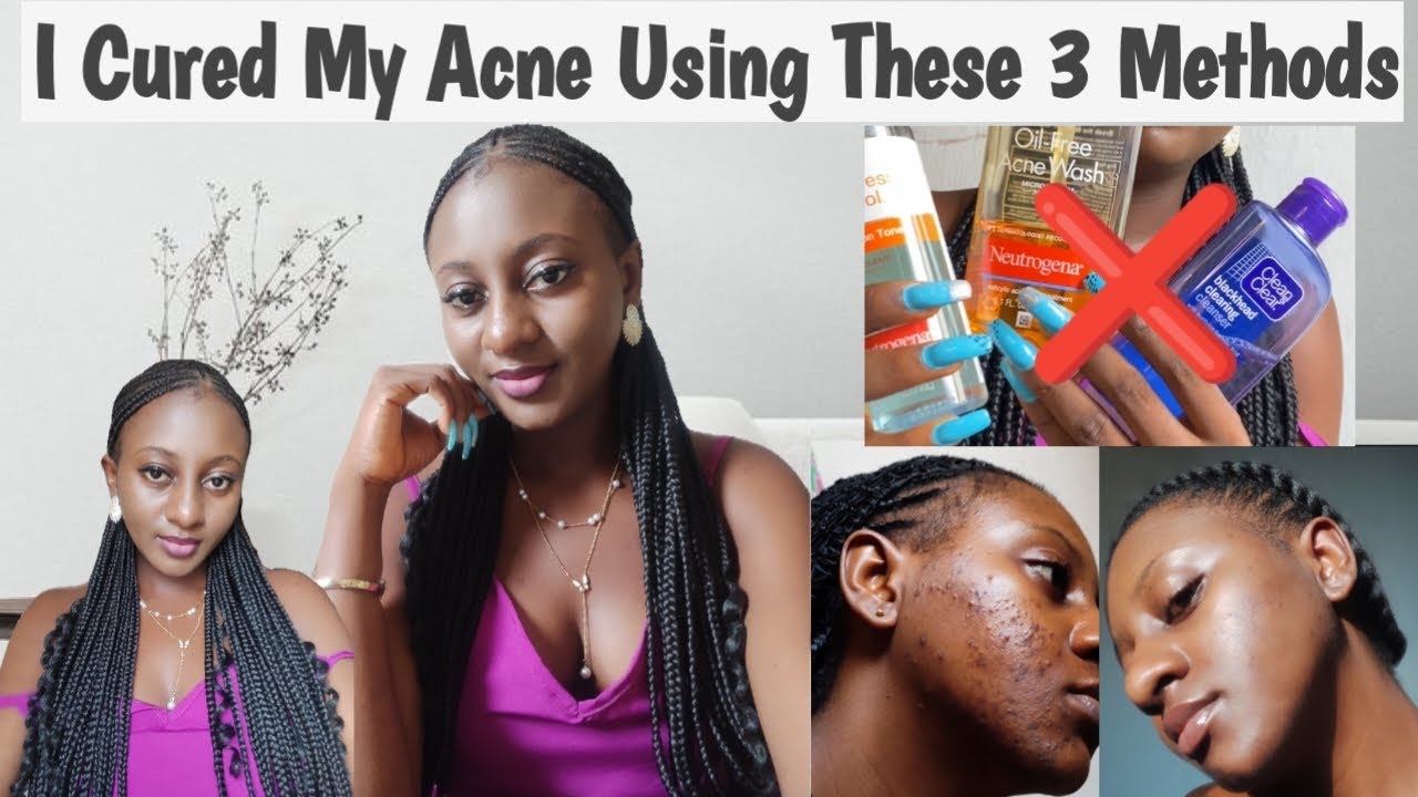 How I Cured My Acne With Just 3 Methods, Skincare To Cure Acne Faster ...