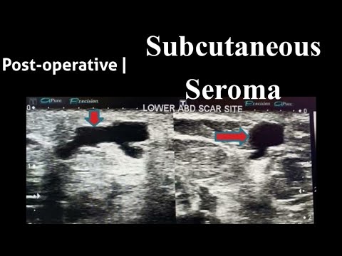 Post-operative Subcutaneous Seroma + Inguinal Lymphadenopathy