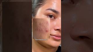 Arencia Vitamin C Booster Shot✅💚 #arencia #hyperpigmentation #vitamincboostershot #bodycare