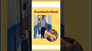 Myo-Electric Hand Prosthesis | Advanced Bionic Hand Technology | Artificial Hand | Nakli Haat