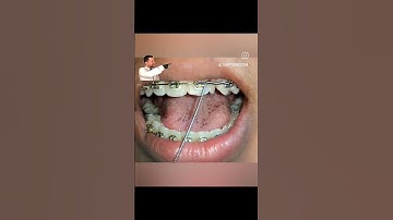 Open coil spring #clinicalorthodontics #practical #orthodontist #opencoilspring