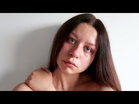 Wideo: Po Wizycie U Chirurga Plastycznego Anna Kałasznikowa Odmówiła Makijażu