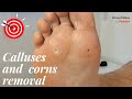 Calluses and corns removal|Καθαρισμός τύλων και κάλων|Κέντρο Ποδιού Podiatry|Ποδιατρική Ποδολογία