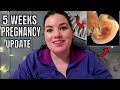 5 weeks pregnancy UPDATE  EARLY PREGNANCY SYMPTOMS