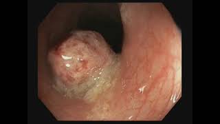 Colonoscopic Polypectomy #BD_ENDOSCOPY