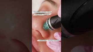 Хотите избавиться от черных точек быстро и безболезненно? HydraFacial – ваша кожа сияет чистотой!