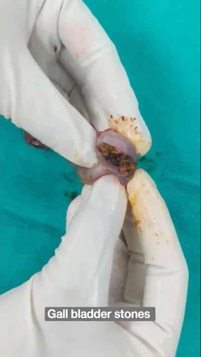 #Gallbladder stones #shorts पित्त की पथरी #healthmedia