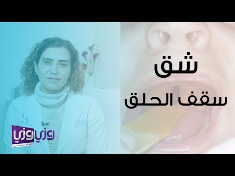 أسباب شق سقف الحلق وعلاجه