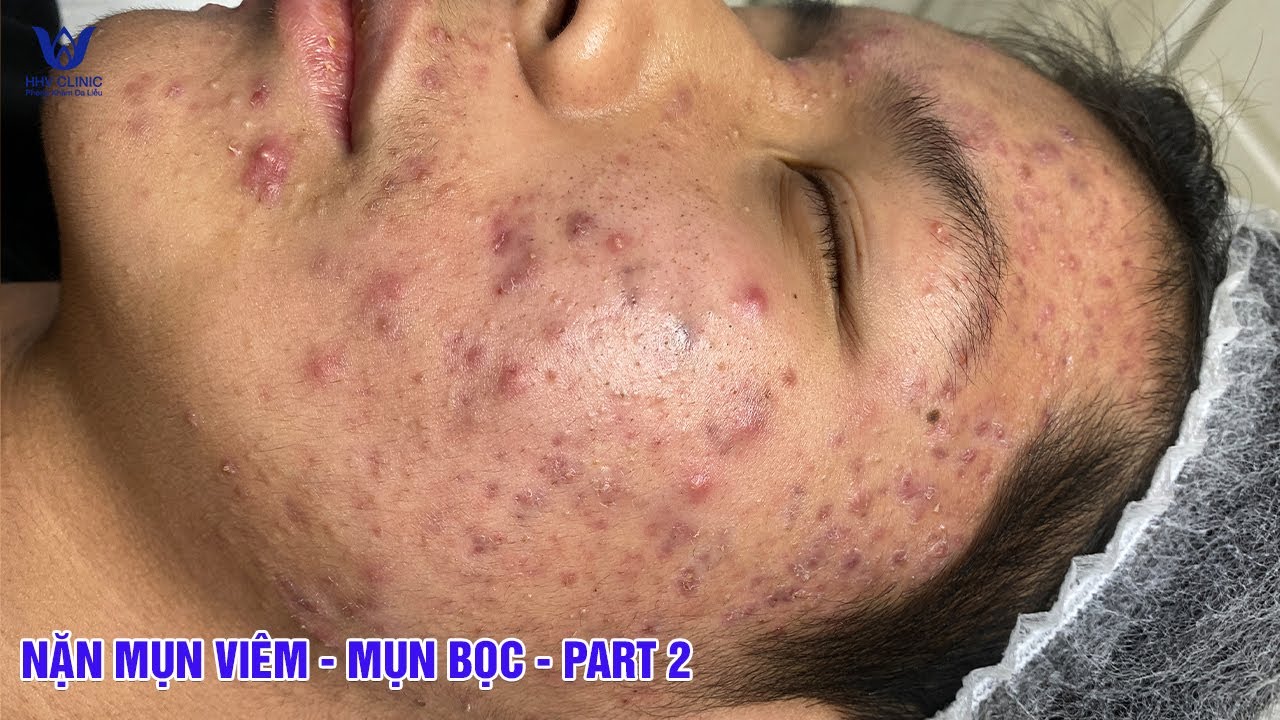 Điều trị mụn viêm, mụn bọc, cam kết hiệu quả ngay sau 1 buổi - Tại phòng khám da liễu HHV Clinic.