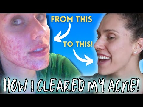 HOW I CLEARED MY ACNE ( Chronic, Cystic, Digestive, Hormonal)