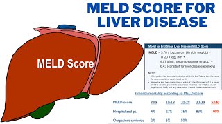 MELD Score for Liver Disease - How is the MELD score used to diagnose liver disease? | 247nht screenshot 3