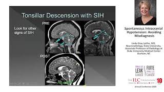 Linda Gray Leithe, MD, Neuroradiology | Spontaneous Intracranial Hypotension: Avoiding Misdiagnosis