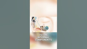 How Cochlear Implants Restore Hearing