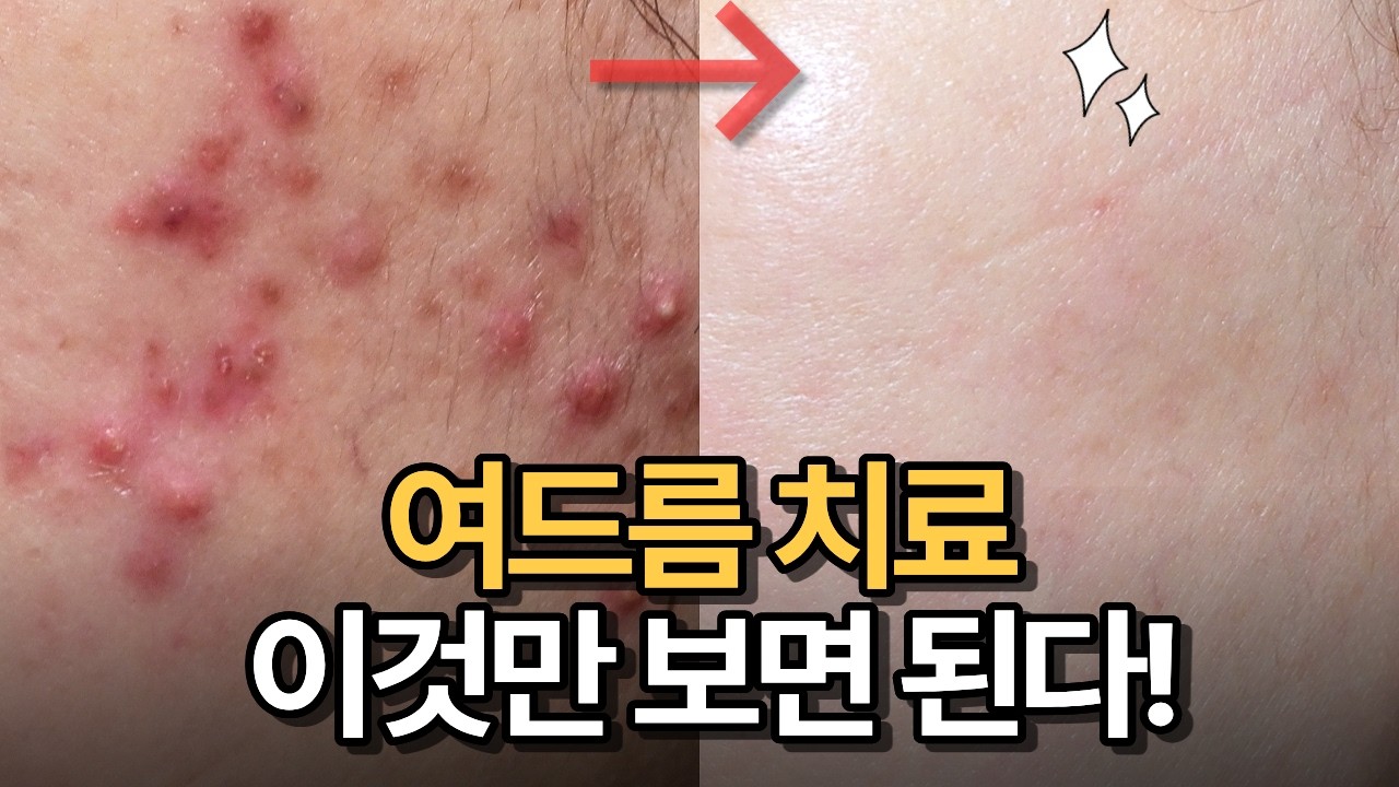 여드름 치료 총정리 최신편! 여드름 종류별 대처방법, 여드름 예방법, 여드름 짜는 법, 흉터관리