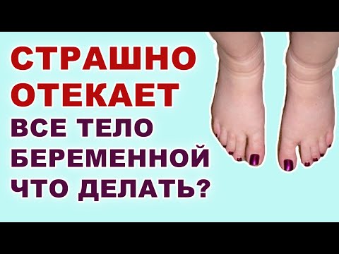 Почему врачи не лечат отечность у беременных на позднем сроке? Как избавиться от отеков беременным?