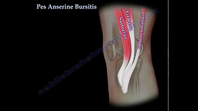 anserine bursitis tünetei és térdkezelése