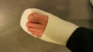 Weißer Oberschenkelgehgips --- Llwc