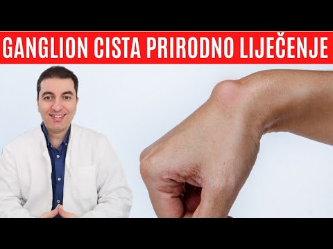 Video: Ganglion Cista Kućno Liječenje