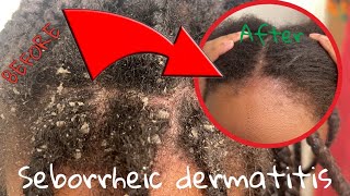 Seborrheic Dermatitis Care on Natural Hair| Dry &amp; Itchy Scalp