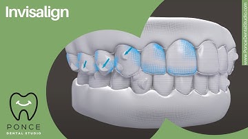 Transform Your Smile with Invisalign | Ponce Dental Studio, Atlanta GA