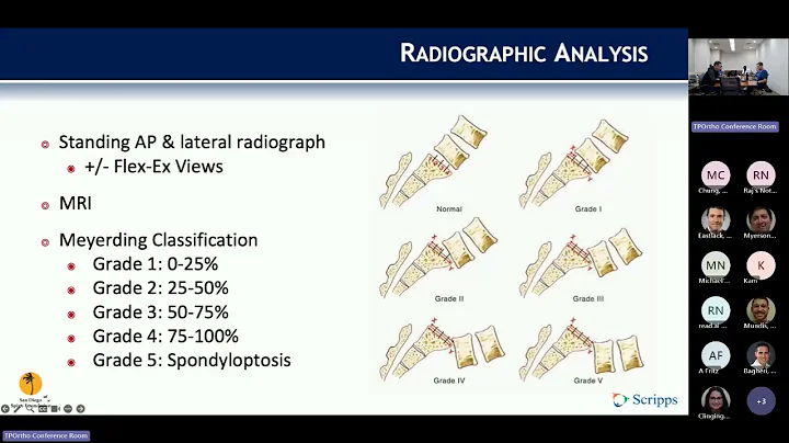 Degenerative Spondylolisthesis : Ryan Finkel, MD on September 8, 2025.