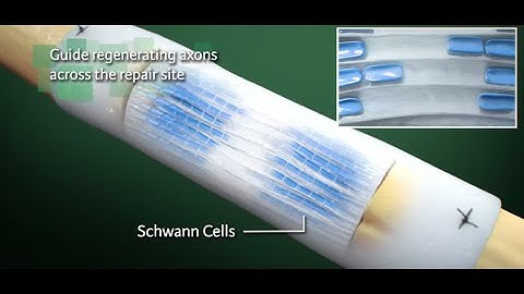 Nerve Repair with NeuraGen Nerve Guide from Integra Life Sciences - Ghost Medical