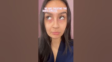 PRP For Dark Circles - Get Brighter Under Eyes