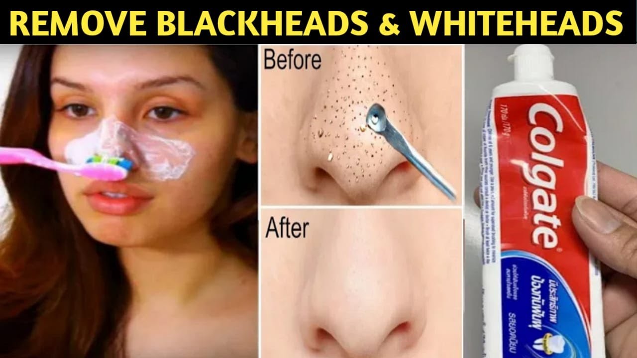 Colgate से Blackheads करे गायब जैसे कभी थे ही 5 Minutes Treatment - How to Remove Blackheads