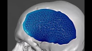 Parametric design of scaffolds for cranioplasty
