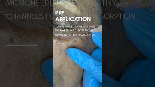Do you have wrinkles, fine lines, acne scars, or dull skin? #glowingskin #prpfacial #beautycare