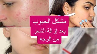 التخلص من مشاكل حبوب الوجه? وإلتهاب البشرة بعد إزالة الشعر ...